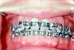 braces banded all teeth 6/29/00 Hand Out photo FEATURES